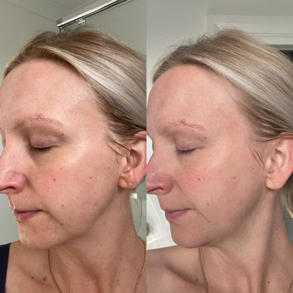 Before and after photo of woman using Biomama Skincare